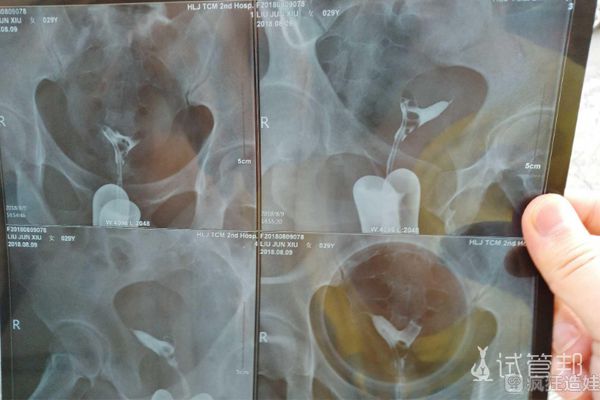 在南部战区总医院做二代试管婴儿成功，分享好孕气