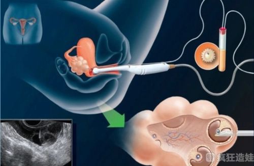 有胚胎第二次移植需要多少钱？已经做过胚胎的移植贵吗？