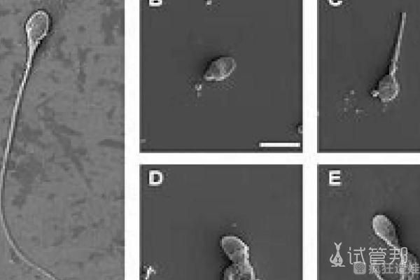 老公弱精症，选择在邵阳市中心医院做第二代试管婴儿