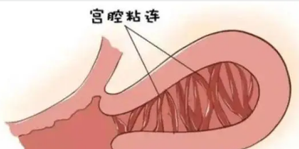轻度宫腔粘连做试管能成功吗-专家分析