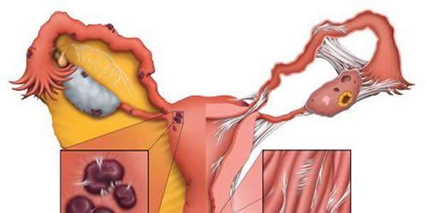 专家解读内异症-良性癌症的恶性后果