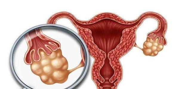 简要解析多囊卵巢能通过试管怀上孩子-你不知道都在这里