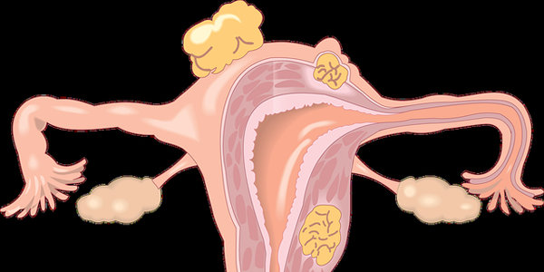 哪些原因会导致卵巢早衰，又该如何保养