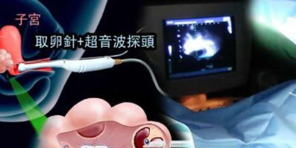 试管婴儿最难熬的是哪一关？听听过来人怎么说