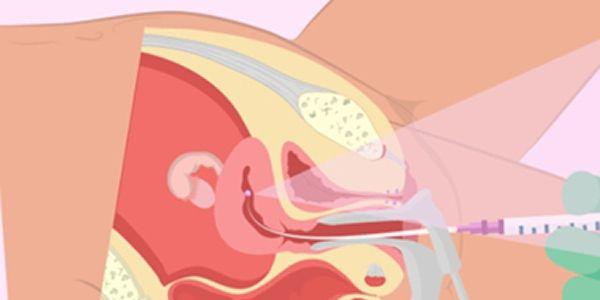 试管移植后胚胎着床失败和成功的症状表现-科普文章