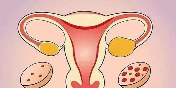 多囊卵巢综合征的5个典型症状表现汇总