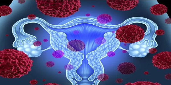 早期宫颈癌的三个预防策略，收藏自救！