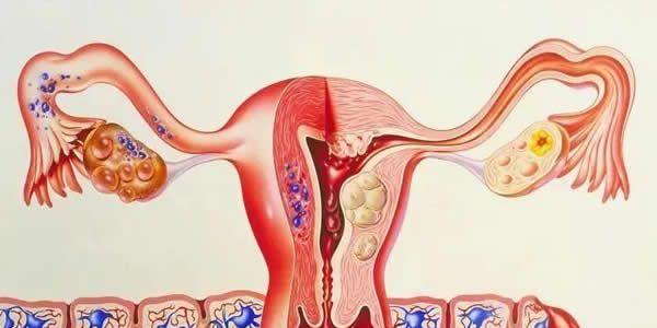 子宫内膜活检的适应症-禁忌症-时间-方法-临床意义
