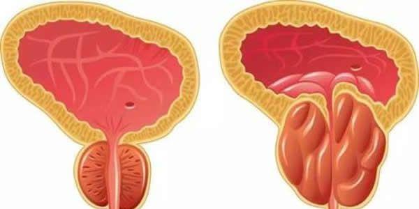 一文解读前列腺炎的4大症状和危害