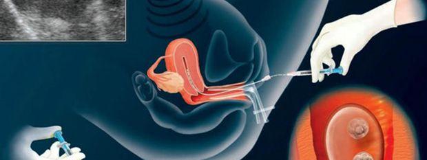 漫画演示试管婴儿进周期具体流程图及步骤让你牢牢掌握试管婴儿知识