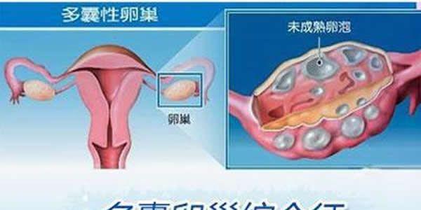 卵巢多囊综合征的4个起因和5个症状「医学剖析」