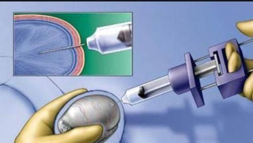 无精症能做试管婴儿吗？专家说要分情况！