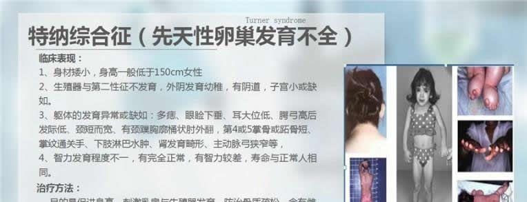 特纳氏综合征是可以做试管婴儿的，但是成功率只有20%左右！