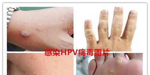 什么是HPV病毒携带者