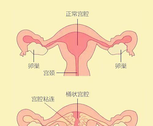 宫腔粘连图文解说-专家医学深度剖析