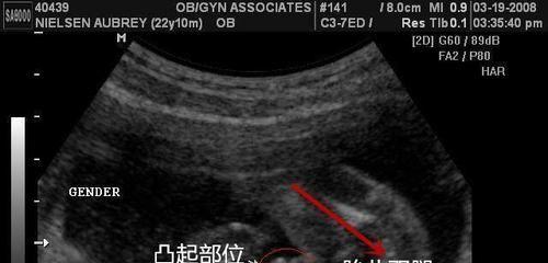 早期孕囊形状看性别图片圆形是男孩这个说法准吗-数据对比一目了然