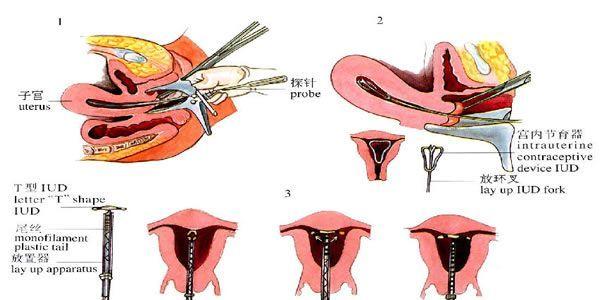 为什么上环能避孕？节育器有几种？附图片