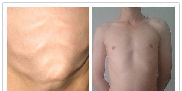 鸡胸和正常人区别图片-专家解析小孩鸡胸病的起因、预防和治疗