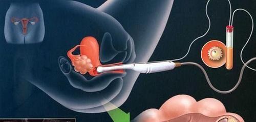 试管婴儿的具体步骤和具体费用和成功率