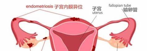 子宫内膜异位症的详细解读