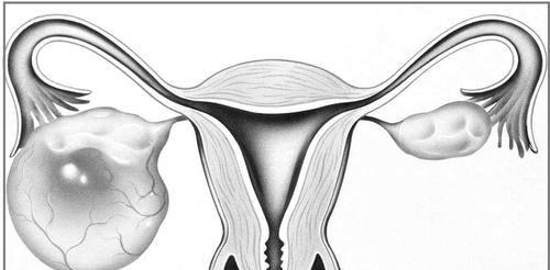 卵巢囊肿要人命？ 找出对症不心慌