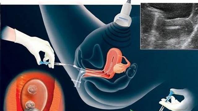 胚胎移植几颗好？胚胎移植数量要求和建议