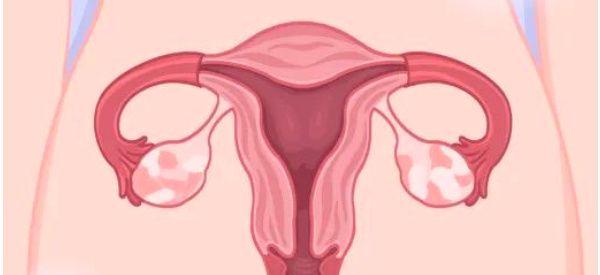 巧克力囊肿做试管婴儿需要什么方案？附注意事项