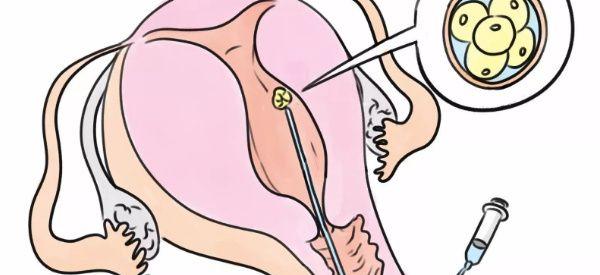 30岁卵巢早衰做试管还有希望吗？选对医院和治疗方案很重要