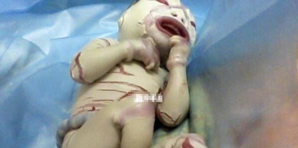 火棉胶婴儿是什么症状？通过图片告诉你有多可怜！