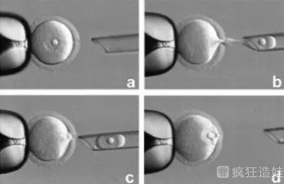 真的有四代试管技术吗？第四代第三代试管婴儿有什么优势？