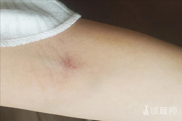 不明原因不孕最终选择做试管婴儿 到促排卵阶段了