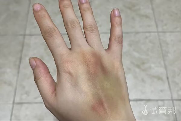 广西壮族自治区生殖医院试管婴儿移植后感受分享