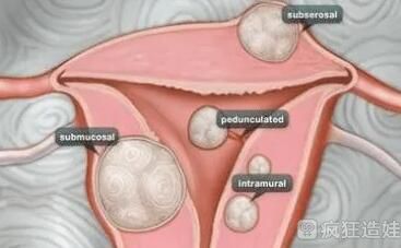 有腺肌症和腺肌瘤能做第三代试管婴儿吗？腺肌症第三代试管婴儿可行吗？