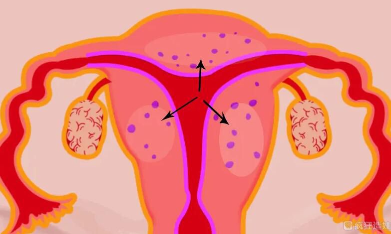 弥漫性子宫腺肌症能做第三代试管婴儿吗？弥漫性腺肌症能生孩子吗？