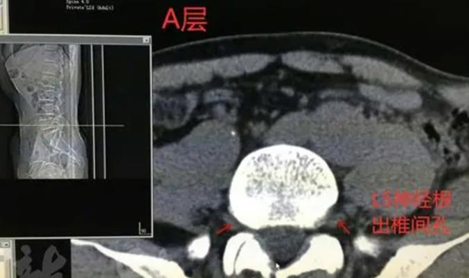 女性骶管囊肿14mm在日常生活中有哪些注意事项?