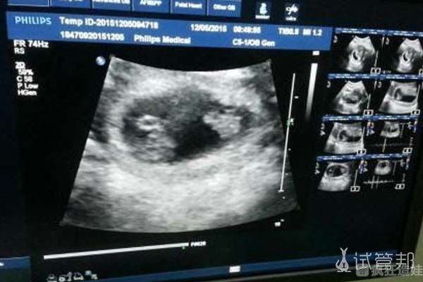 高龄在台湾做试管婴儿的经历