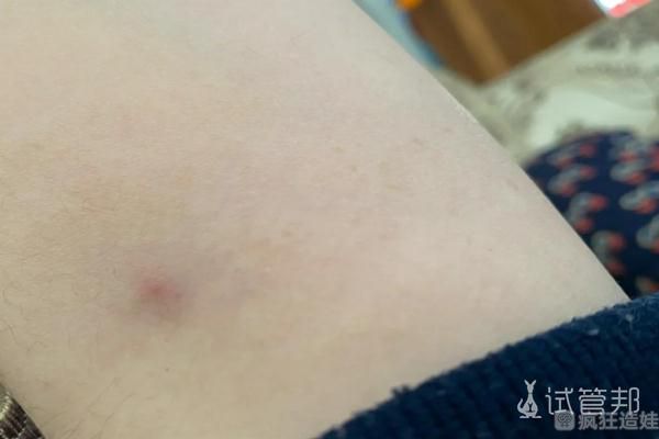 吉林省妇幼保健院做第三代试管婴儿成功进周 太不容易了