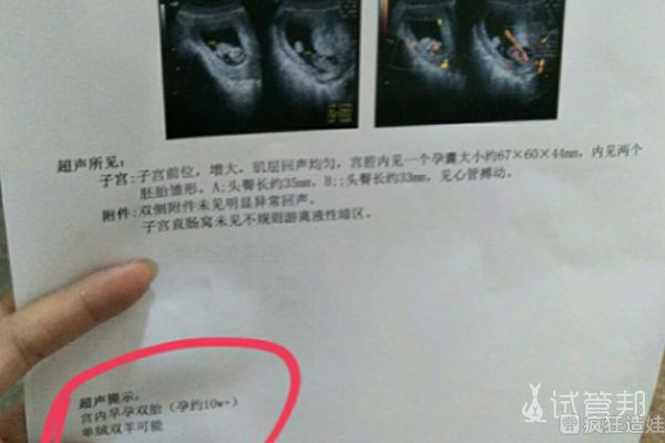 二代试管婴儿取卵1次成功，喜得双胞胎！