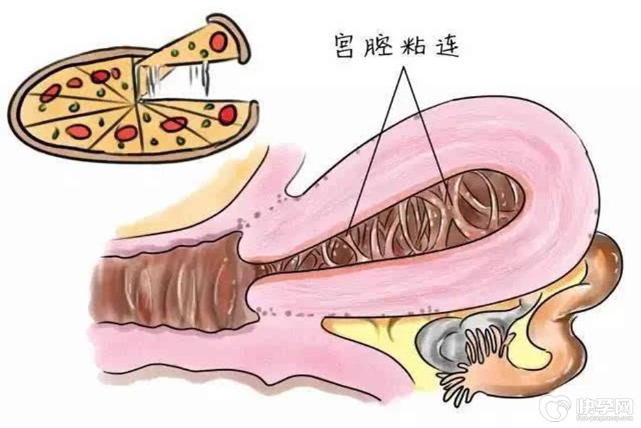 有宫腔粘连可以做试管吗？专家建议先治疗