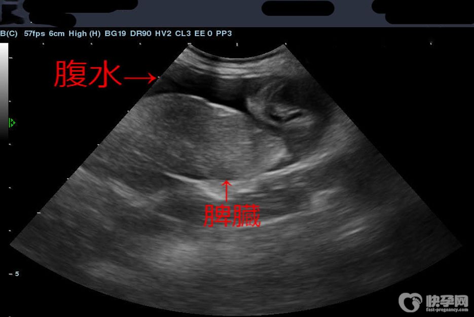 试管取卵之后有腹水怎么办？4个妙招能有效预防腹水！