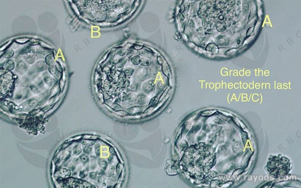 据说格鲁吉亚做三代试管15万左右，都花在了什么地方？