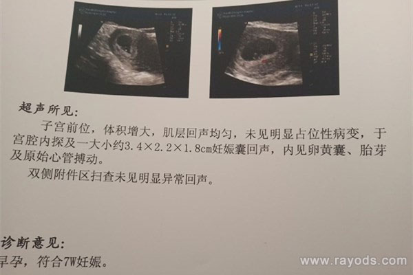 孕囊看男女的方法是什么？四十天孕囊圆形百分百女孩真的吗？