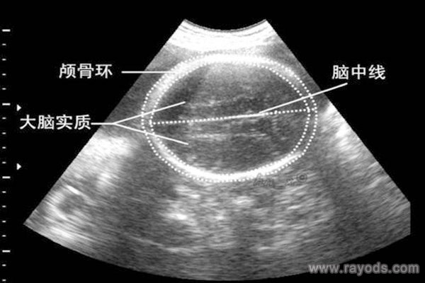 怀儿子双顶径一般都会大吗 胎儿双顶径偏大怎么办