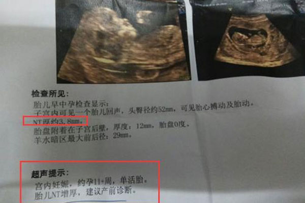 nt增厚怎么回事 nt增厚后期吸收了就没事了吗