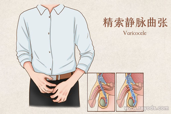 双侧重度精索静脉曲张是什么原因引起的？