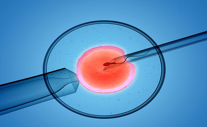第一、二、三、四代试管婴儿技术的原理和区别