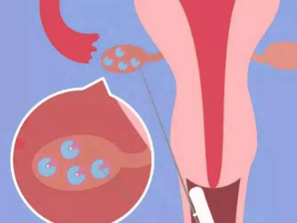 取卵后女人真容易提前衰老，加速卵巢刺激恢复迫在眉睫