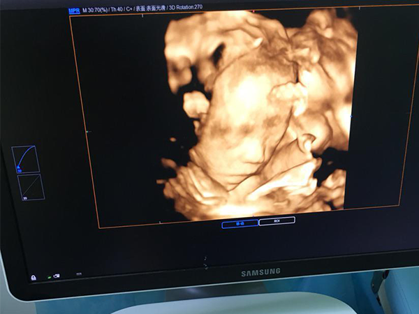 四维彩超的图片暗藏玄机，这些看生儿子的小技巧一定要get到