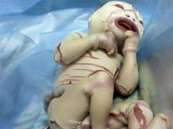 带你走近小儿Hebra脂溢性鱼鳞病，干燥脱皮是主要表现