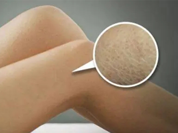 轻微鱼鳞皮肤病能自愈是谣言，做好缓解措施才是正解